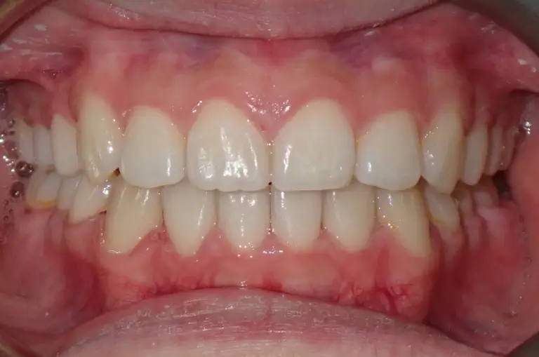 form-ortho-result-49-after